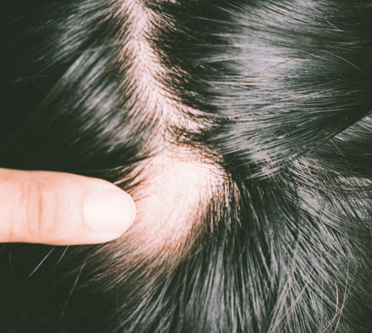 Todo lo que debemos saber de la alopecia areata